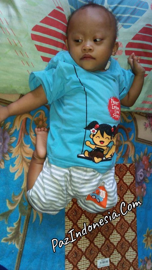 bedong pengobatan down syndrom secara alami tanpa obat