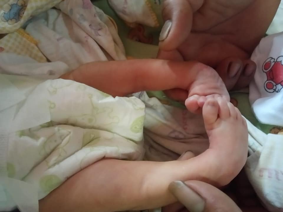 terapi bedong paz keluhan baby clubfoot 1