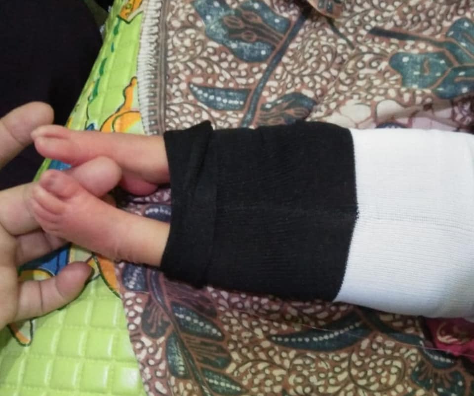terapi bedong paz meninggal club foot terapi gedong paz al kasaw
