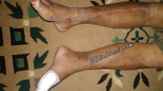 Pengobatan Gangren, Gangren Bukan Karena Diabetes, Karena Melintir!