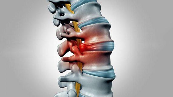 Pengobatan Syaraf Terjepit di Punggung Secara Alami