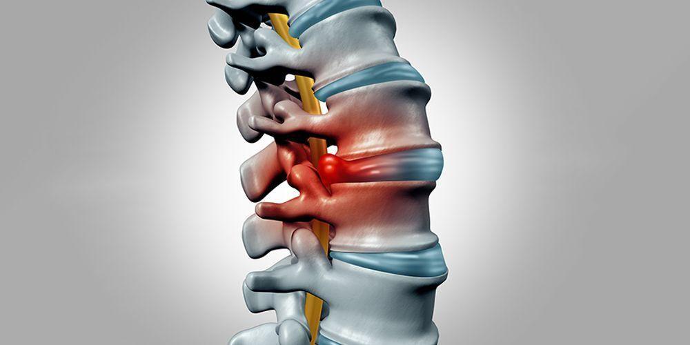 Pengobatan Syaraf Terjepit di Punggung Secara Alami