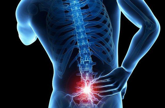 Pengobatan Syaraf Terjepit di Leher Secara Alami