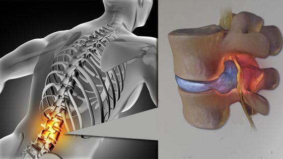 Pengobatan Terapi HNP Cervical Secara Alami