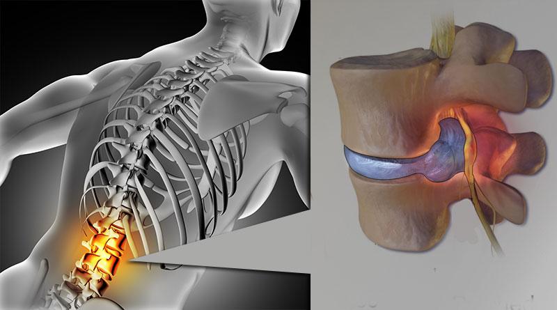 Pengobatan Terapi HNP Cervical Secara Alami