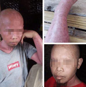 autoimun psoriasis vulgaris psoriatic arthritis pengobatan penyaki autoimun gatal terus seluruh badan autoimun
