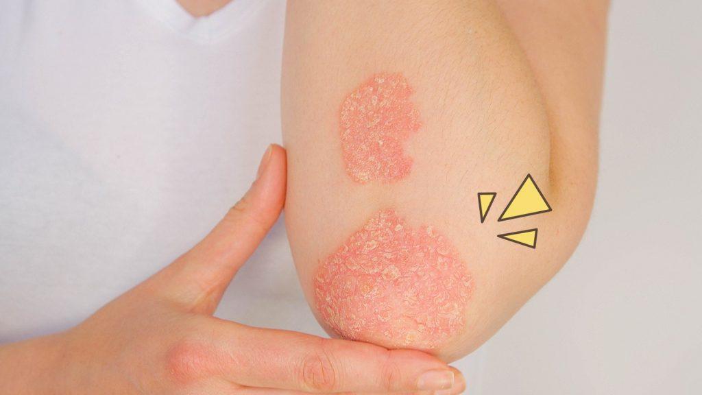 Seberapa Hebatkah Pengobatan PAZ Autoimun Ini Penjelasannya!