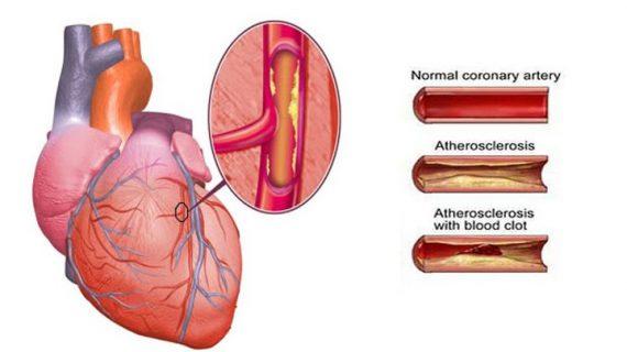 Cintai Jantung Mu Dengan Obat-Obatan Alami