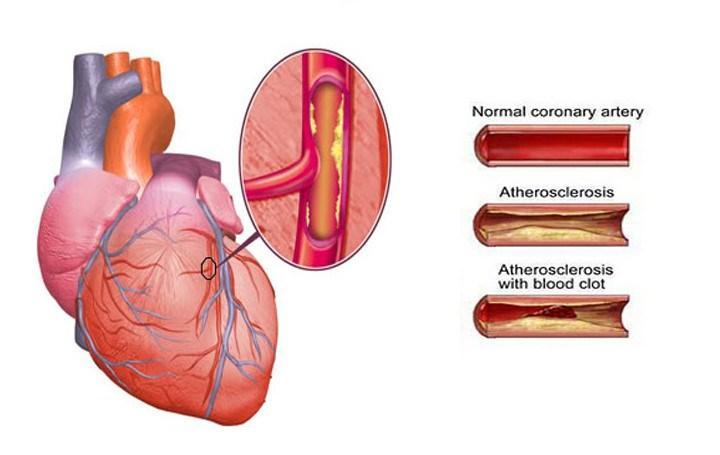 Cintai Jantung Mu Dengan Obat-Obatan Alami