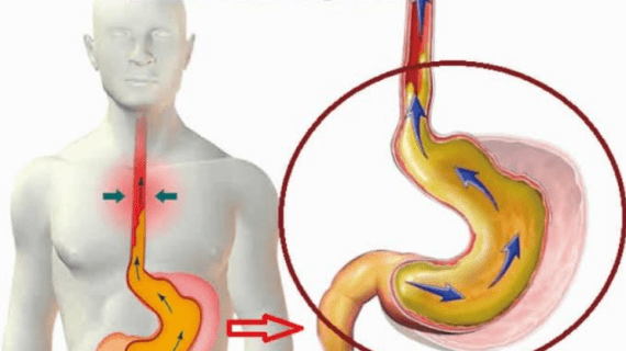 5 Cara Terbaik Mengatasi Asam Lambung yang Naik
