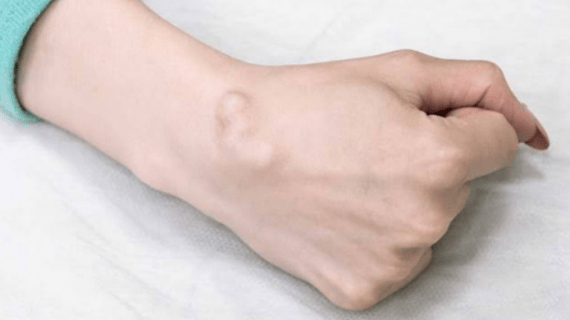 5 Gejala Penyakit Kista yang Jarang Dikenali