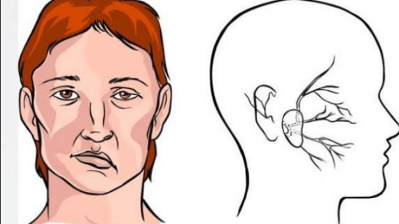 5 Tips Pengobatan untuk Penyakit Stroke Ringan