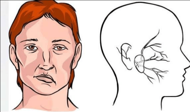 5 Tips Pengobatan untuk Penyakit Stroke Ringan