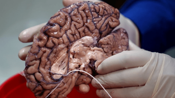 7 Kebiasaan Buruk yang Bisa Menyebabkan Kanker Otak