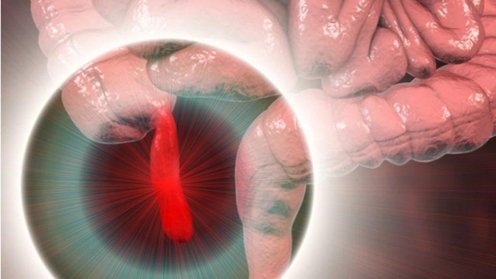 Cara Alami Atasi Usus Buntu