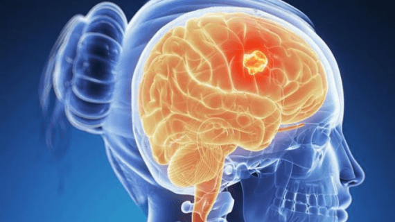Inilah Gejala Tumor Otak yang Wajib Diketahui