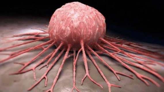 Inilah 7 Kebiasaan Buruk yang Bisa Memicu Kanker Payudara