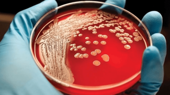 Kenali 5 Penyebab Penyakit Kanker Darah