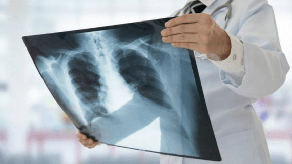 Kenali Gejala-gejala Penyakit TBC Sejak Dini