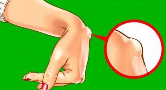 Kenali Penyebab Terjadinya Lipoma