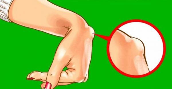 Kenali Penyebab Terjadinya Lipoma