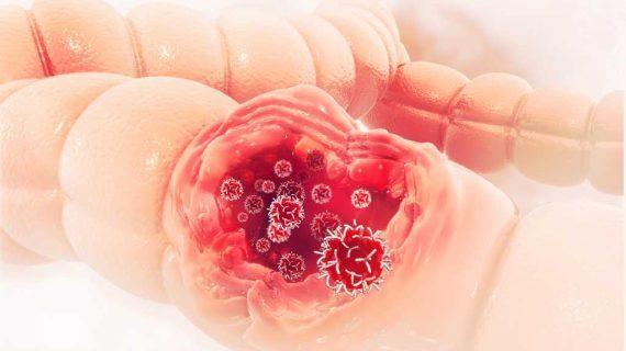 Pecegahan Kanker Pada Usus Besar Melalui Makanan