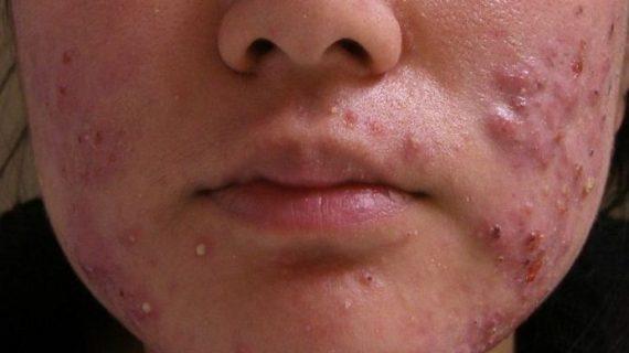 Seputar Cara Alami Mengatasi Jerawat