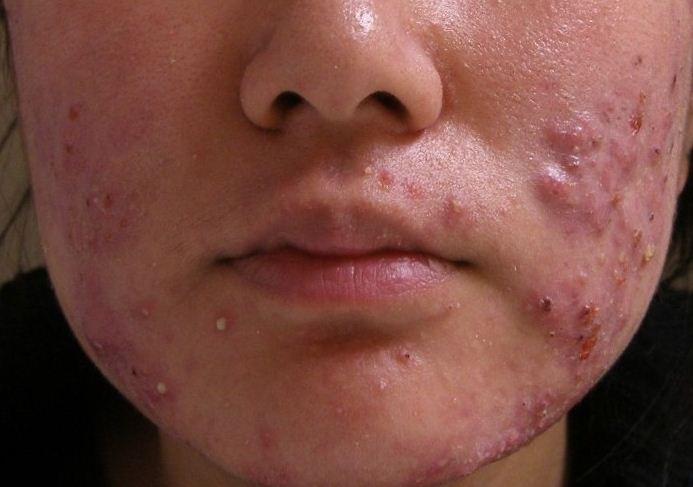 Seputar Cara Alami Mengatasi Jerawat