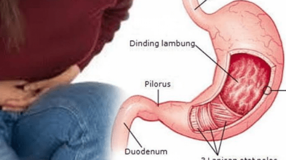 Terapi untuk Penyakit Asam Lambung