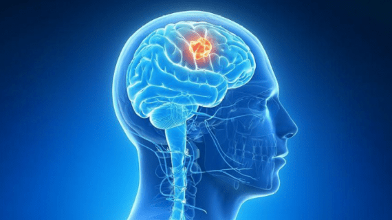 Tips Mencegah Serangan Penyakit Kanker Otak