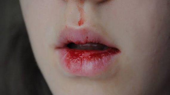 Waspadai Gejala Munculnya Mimisan