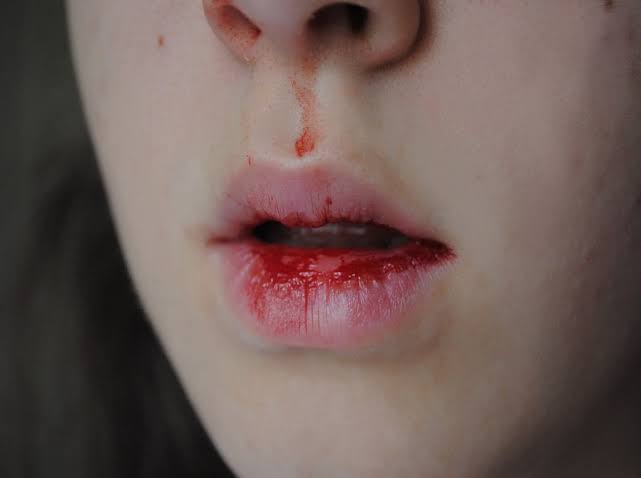 Waspadai Gejala Munculnya Mimisan