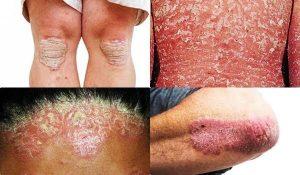 testimoni terapi psoriasis vulgaris metode paz al kasaw