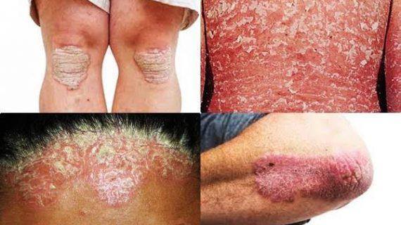 Terapi Psoriasis Vulgaris dengan PAZ Al Kasaw, Solusi Autoimun Alamiah