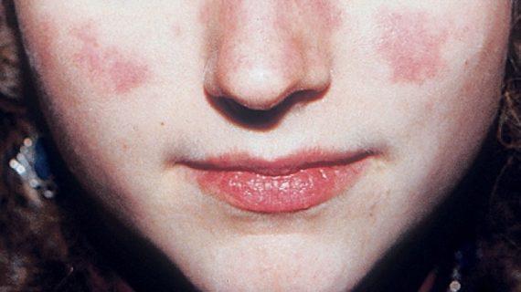 Mengenali Penyebab Serta Gejala Lupus Yang Muncul