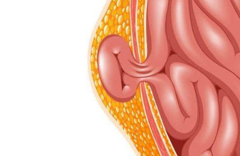 Mewaspadai Adanya Gejala Penyakit Hernia