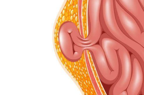 Mewaspadai Adanya Gejala Penyakit Hernia