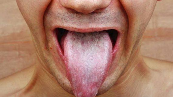 Solusi Pengobatan Atasi Penyakit Kanker Mulut