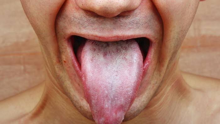 Solusi Pengobatan Atasi Penyakit Kanker Mulut