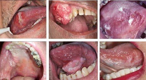 Waspadai Adanya Gejala Kanker Mulut