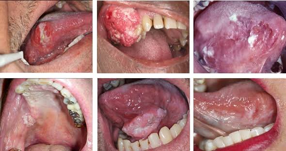 Waspadai Adanya Gejala Kanker Mulut
