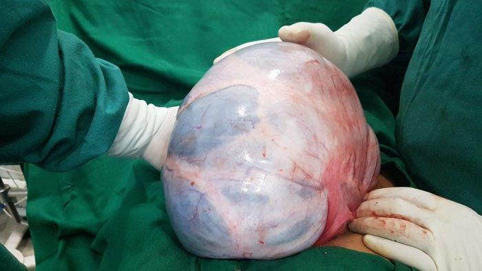 Adanya Perbedaan Antara Tumor dan Kanker