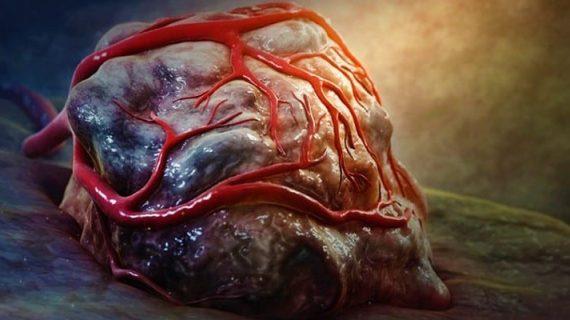 Ketika Penyakit Tumor Dikatakan Jinak