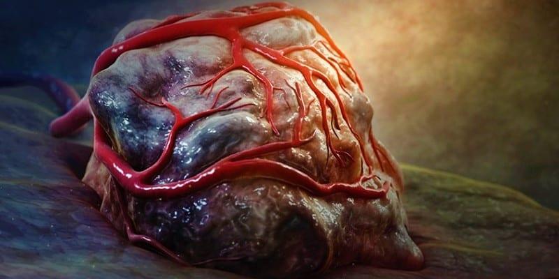 Ketika Penyakit Tumor Dikatakan Jinak