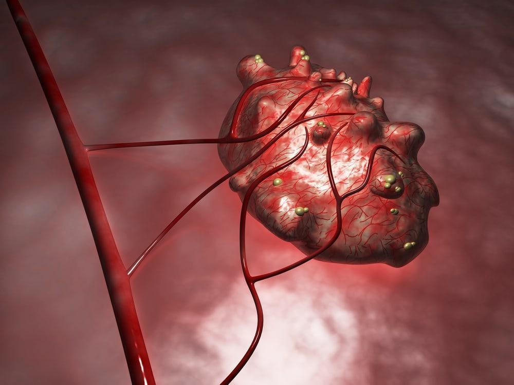 Manfaat Tumbuhan Alami Untuk Mengatasi Penyakit Tumor