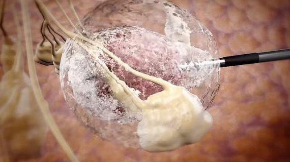 Waspadai Adanya Gejala Serta Resiko Tumor Pada Otak