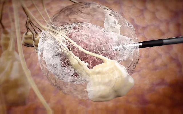 Waspadai Adanya Gejala Serta Resiko Tumor Pada Otak