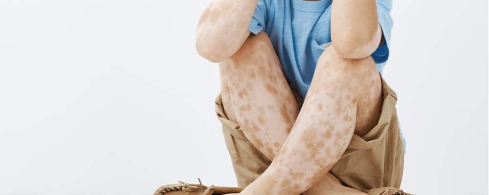 Waspadai Penyebab Serta Gejala Yang Muncul Akibat Penyakit Autoimun