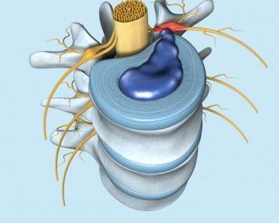 Bagaimana Pengobatan Syaraf Kejepit (HNP) dan Jantung Untuk Remaja