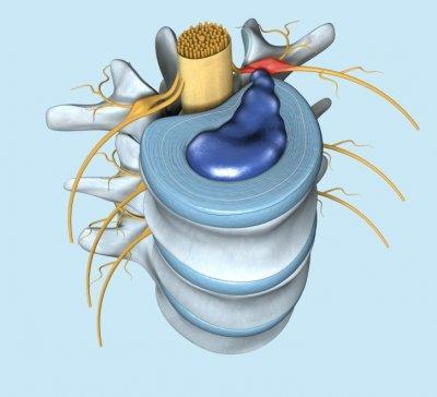 Bagaimana Pengobatan Syaraf Kejepit (HNP) dan Jantung Untuk Remaja
